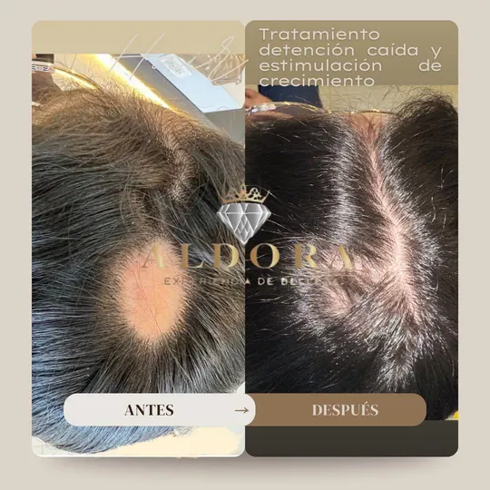 Before and after: a bald patch filling back in with the anti-hair loss treatment