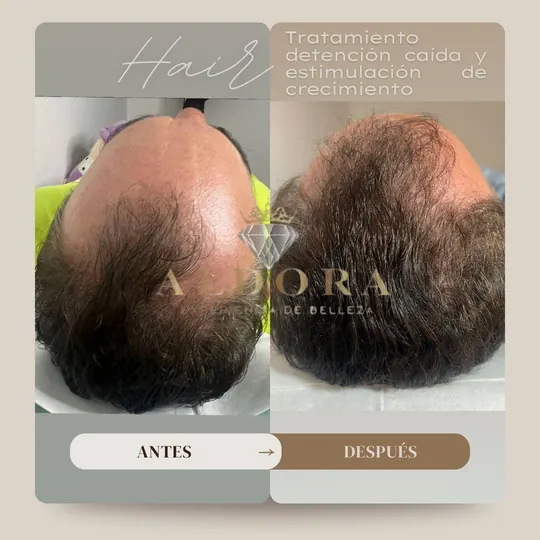 Before and after: a man's crown with more density after the anti-hair loss treatment