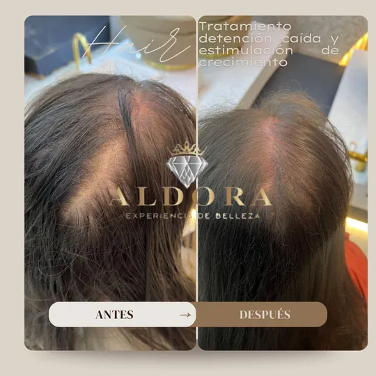 Before and after: a part with less visible scalp after the anti-hair loss treatment